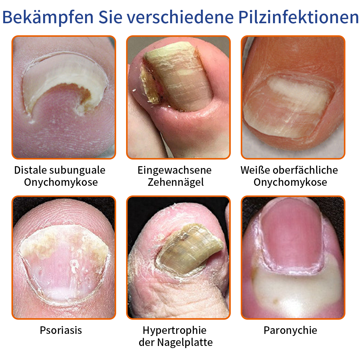 🐝🐝Furzero™ rozwiązanie na grzybicę paznokci jadem pszczelim: Całkowicie rozwiązuje problem grzybicy paznokci🌟👣