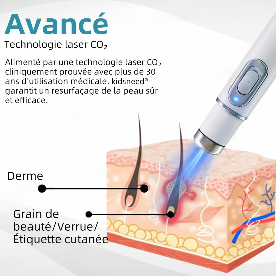 kidsneed® Nieinwazyjny laser do usuwania wągrów i brodawek ✨✨✨