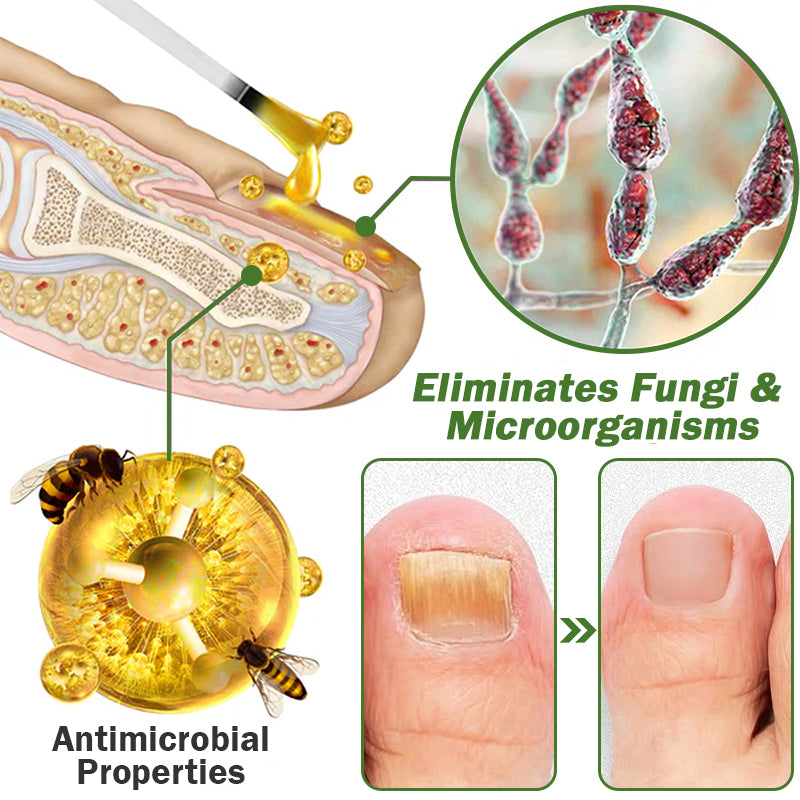 👩‍⚕️Furzero™ Nail Defense Bee Venom Treatment Serum (na wszystkie rodzaje chorób paznokci✅ dla zdrowszego wzrostu paznokci)