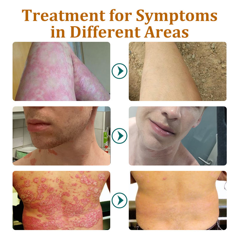 Furzero™ Bee Venom Psoriasis Treatment Cream (AAD RECOMMENDS)