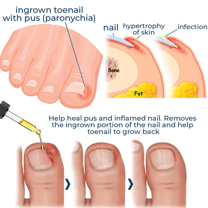 ToenailPlus™ Anti Paronichia Relief Ulei